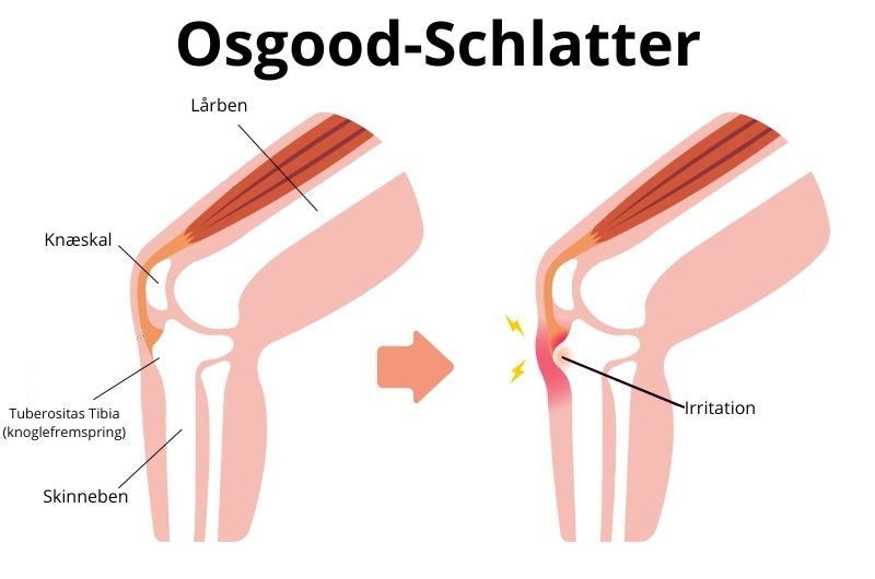 billeder-til-blog/knaesmerter-boern-og-unge/osgood-schlatter.jpg